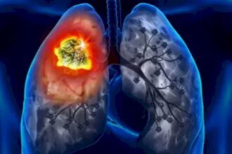روسيا تسجل دواء مبتكرا لعلاج سرطان الرئة