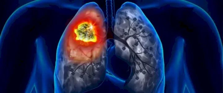 روسيا تسجل دواء مبتكرا لعلاج سرطان الرئة
